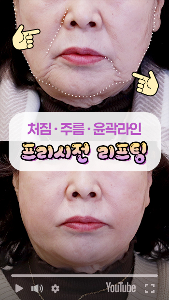 콜라겐실리프팅 썸네일