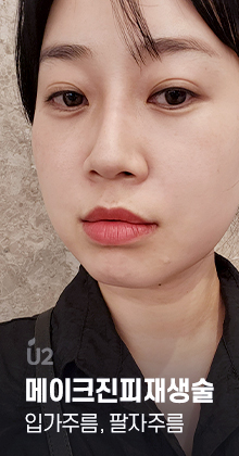 팔자주름 Real Before After! #shorts